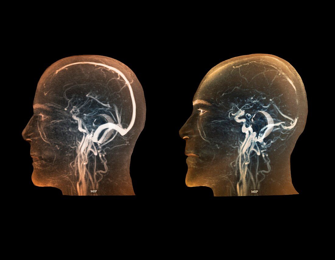 Thrombophlebitis in the brain,MRI scans