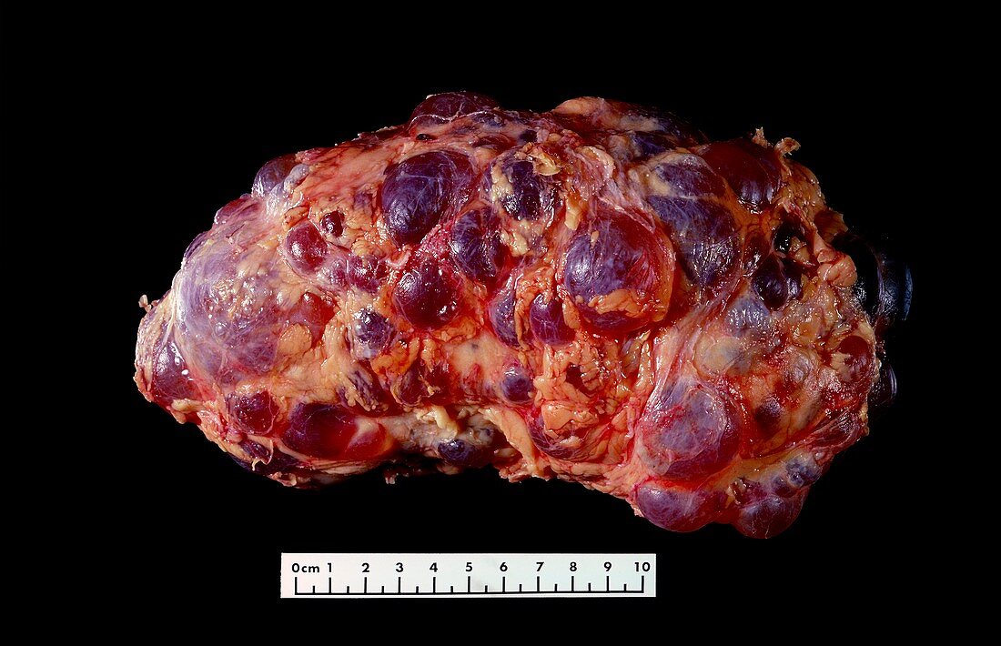 Polycystic kidney