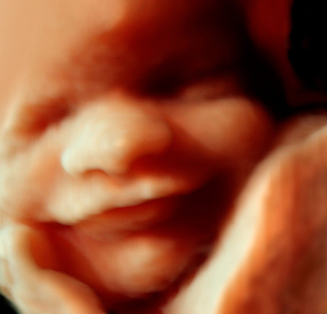 32 week foetus,3-D ultrasound scan