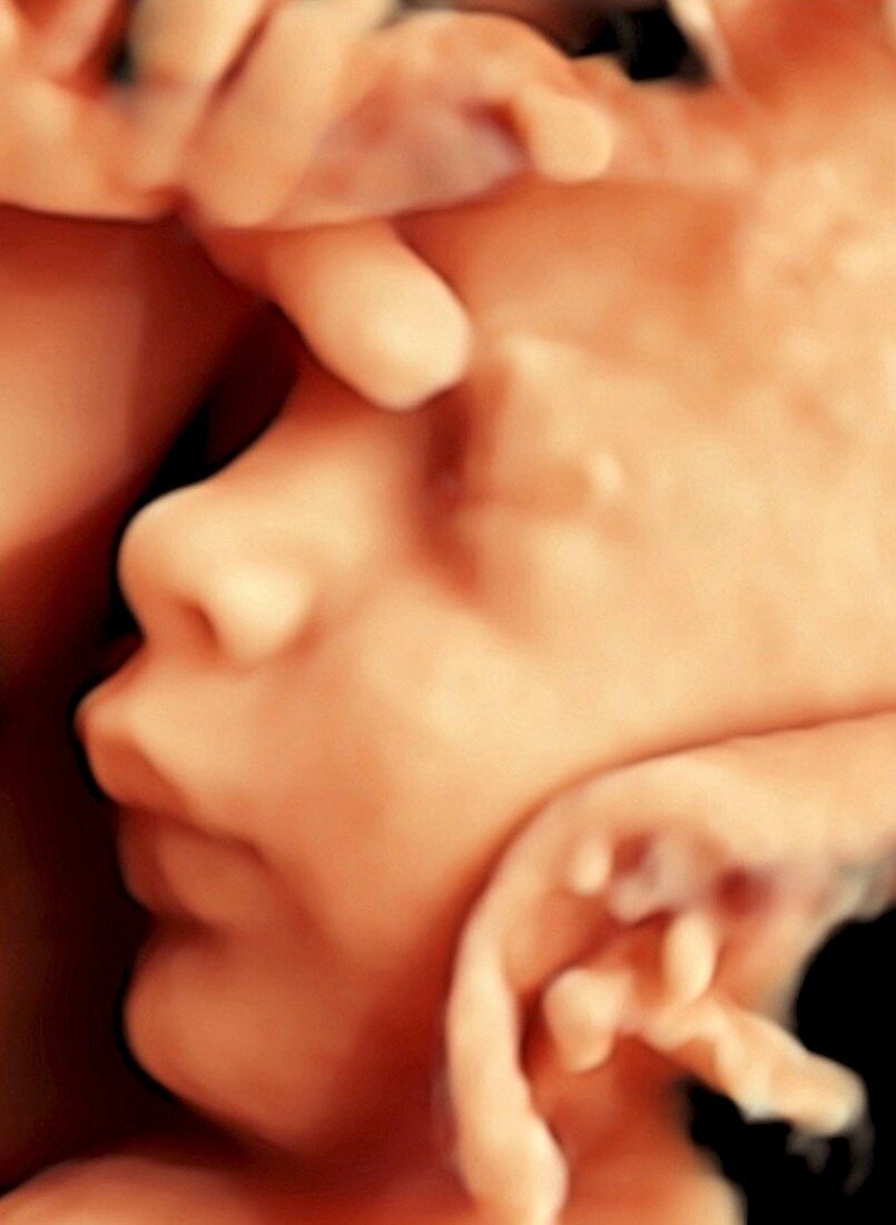 28 week foetus,3-D ultrasound scan