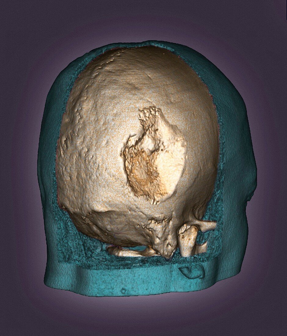 Gorham's disease,3D CT scan