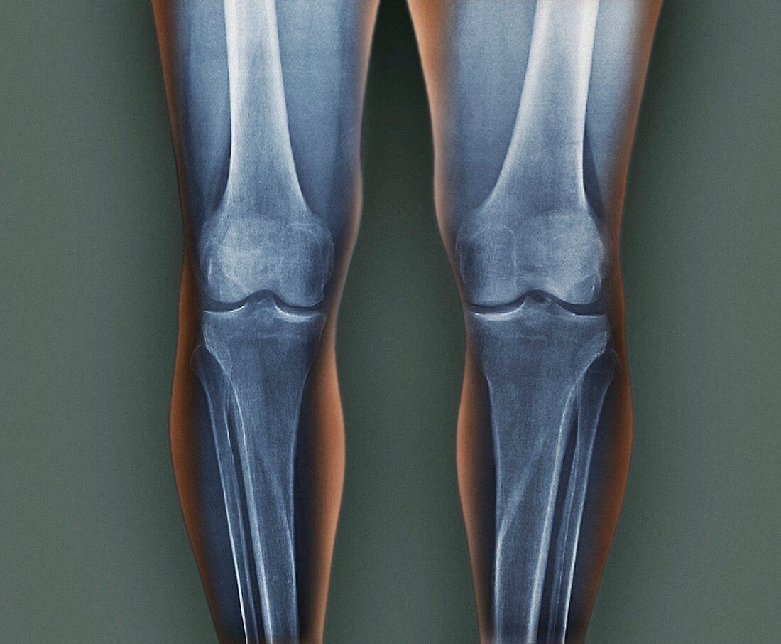 Normal knees,X-rays