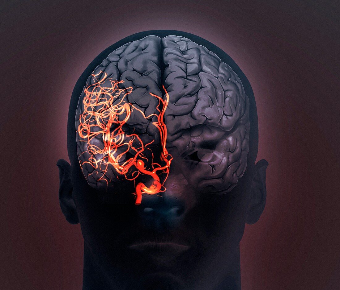 Brain aneurysm,3D scan