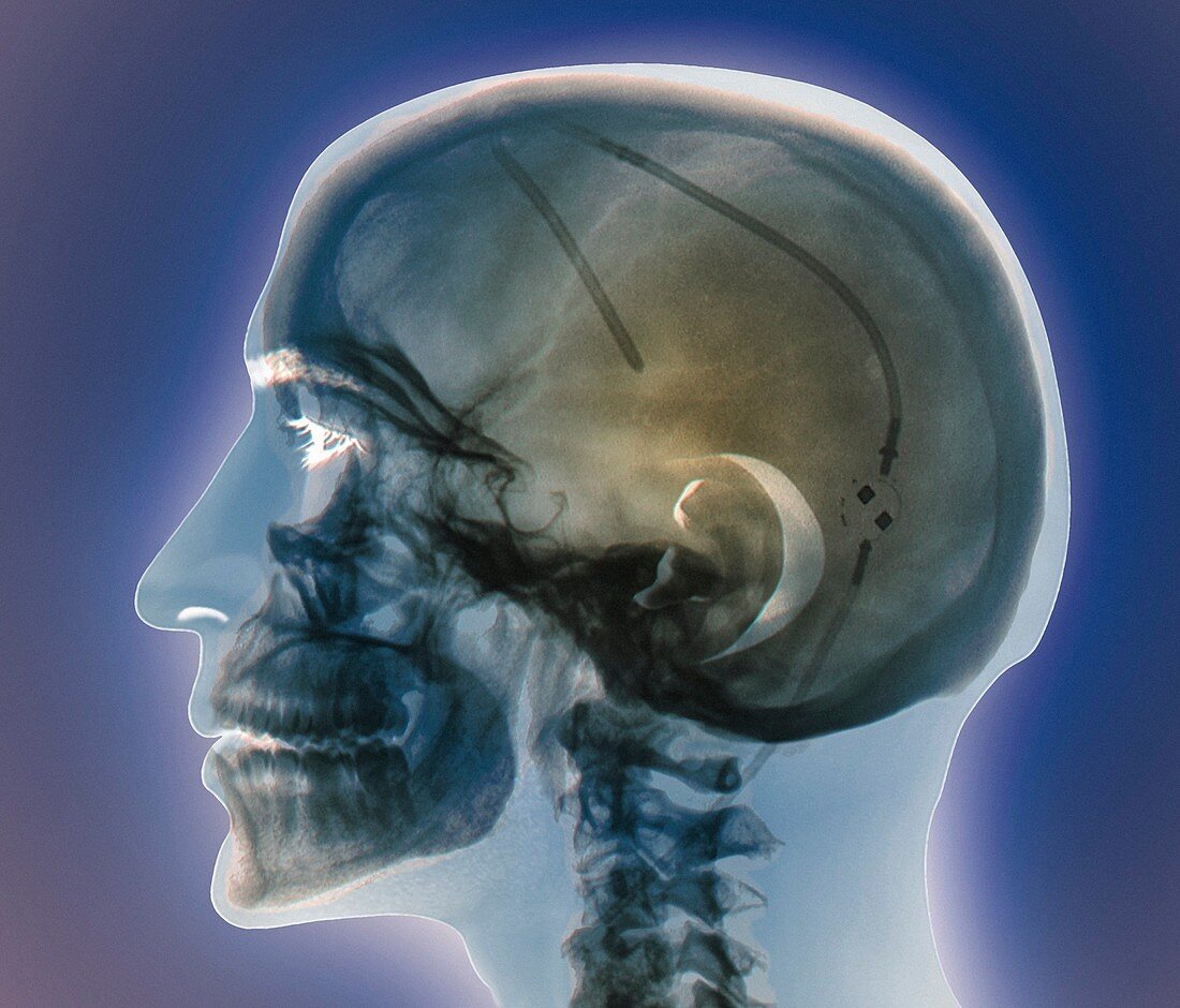 Ventricular shunt,X-ray