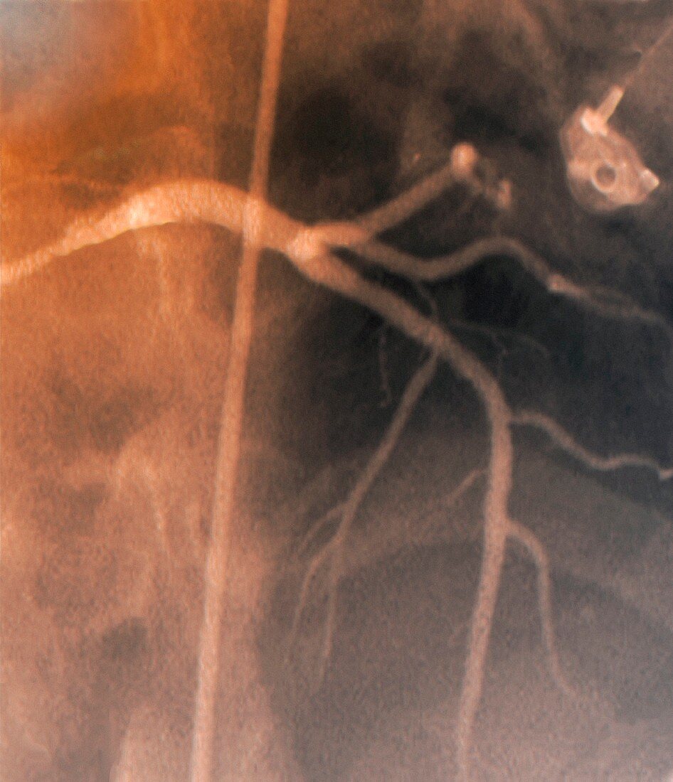 Coronary stenosis after treatment,X-ray