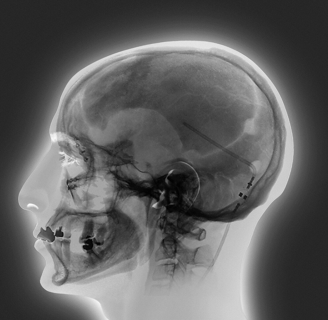 Ventricular shunt,X-ray