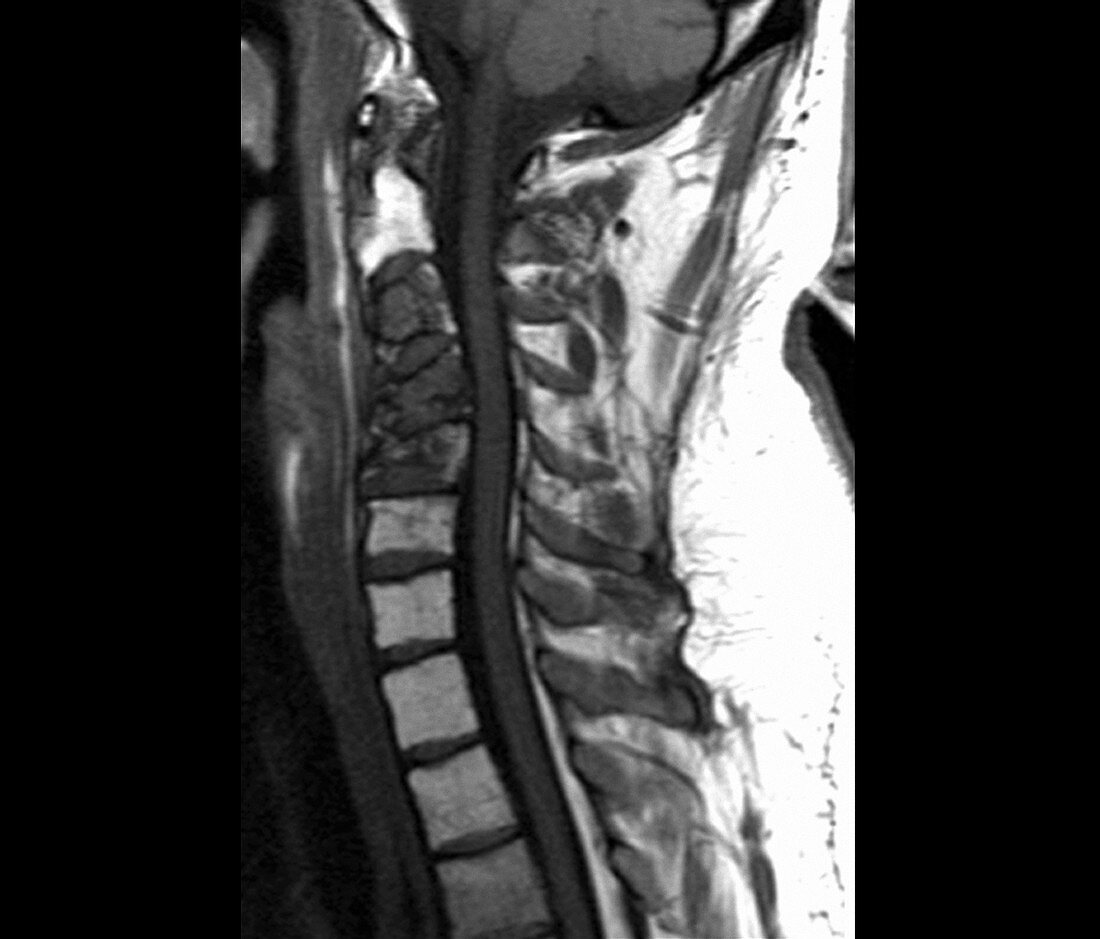 Spinal cancer,MRI scan