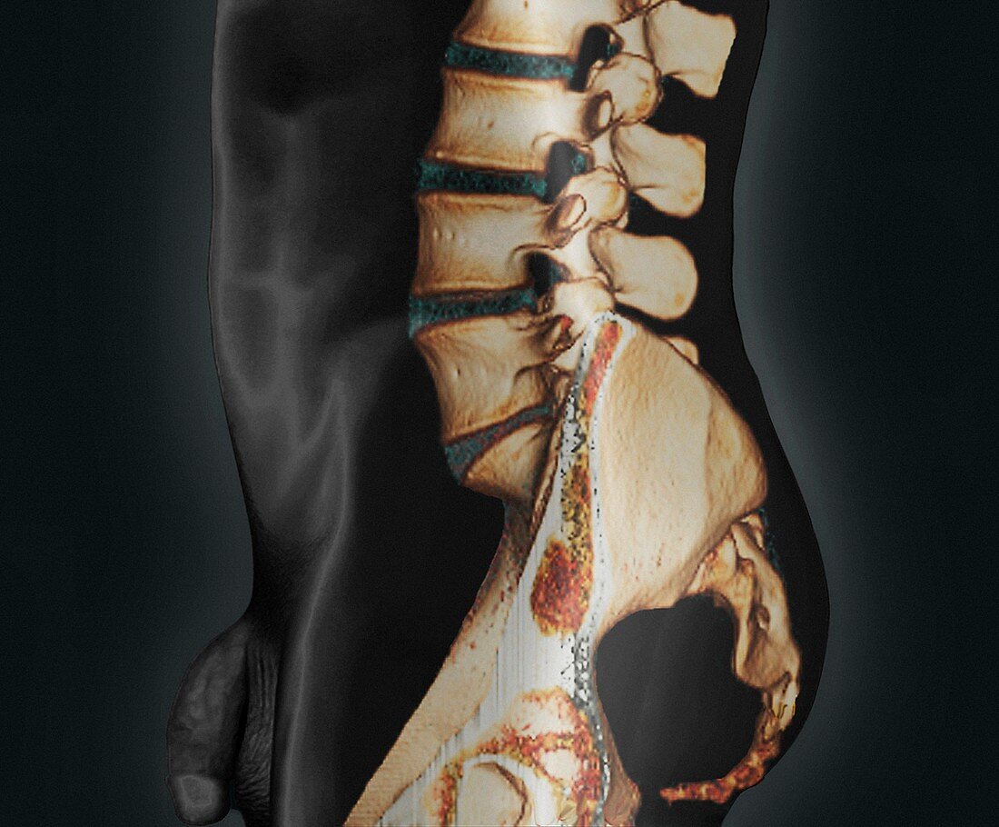 Normal lower spine,CT scan