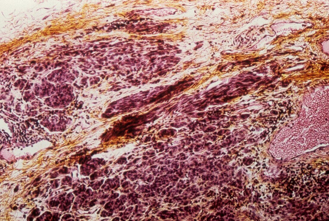 Skin cancer,micrograph