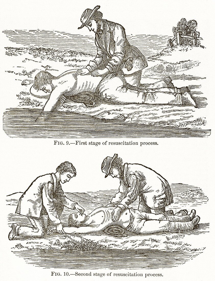 Emergency resuscitation,19th century