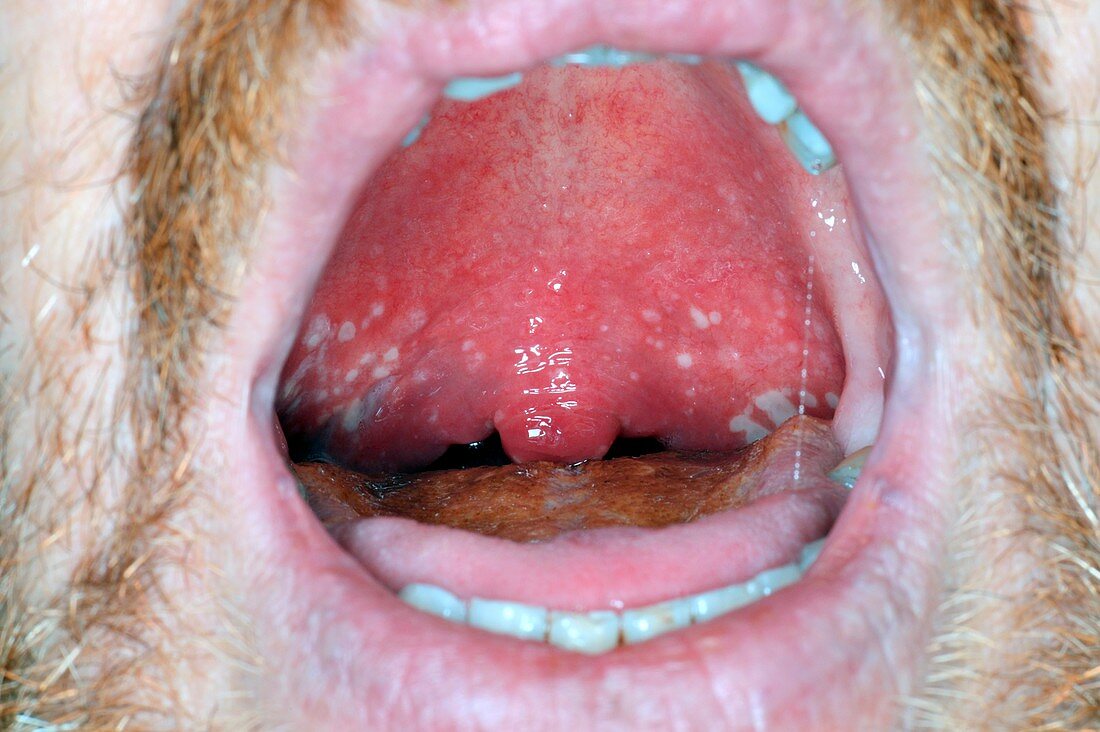 Oral thrush after antibiotic treatment
