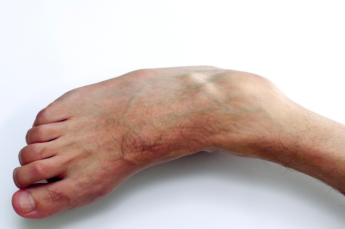 Club foot in Charcot-Marie-Tooth disease