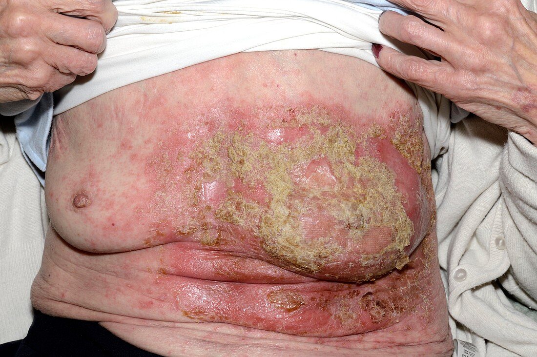 Psoriasis on breast before treatment