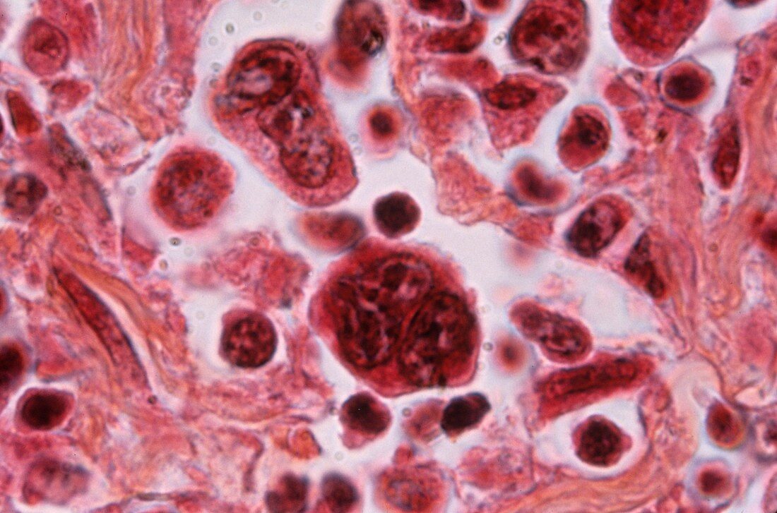 Hodgkin's lymphoma,light micrograph