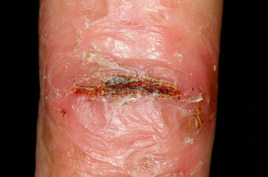 Skin fissure due to eczema