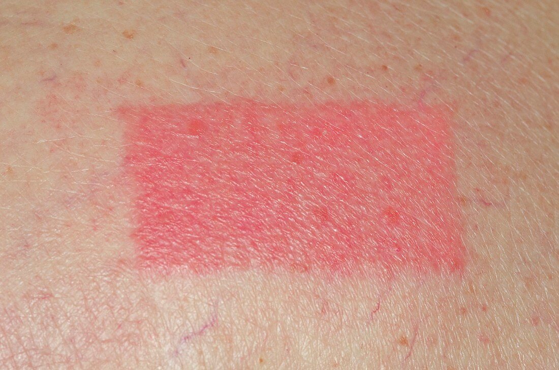 Allergic reaction to skin patch