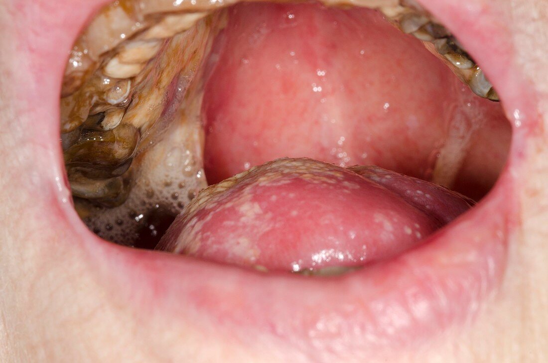 Oral thrush in mouth cancer