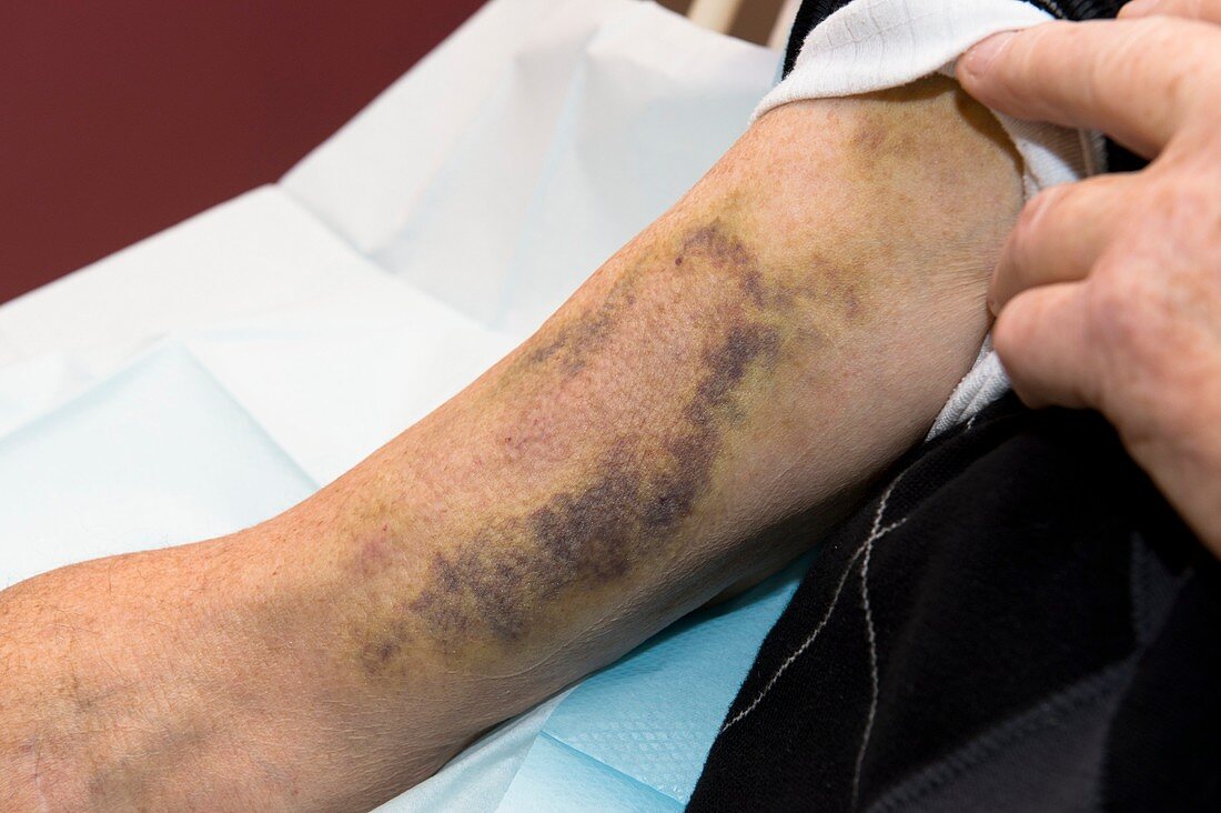 Haemodialysis: bruised arm