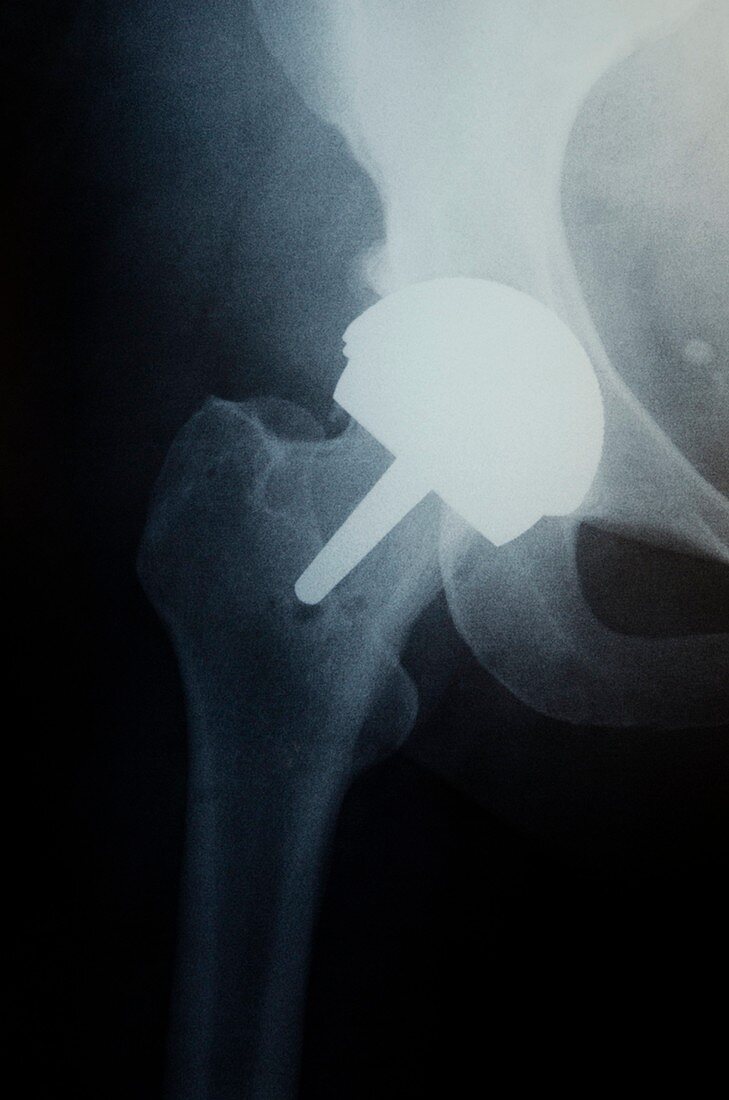 Artificial hip joint,X-ray