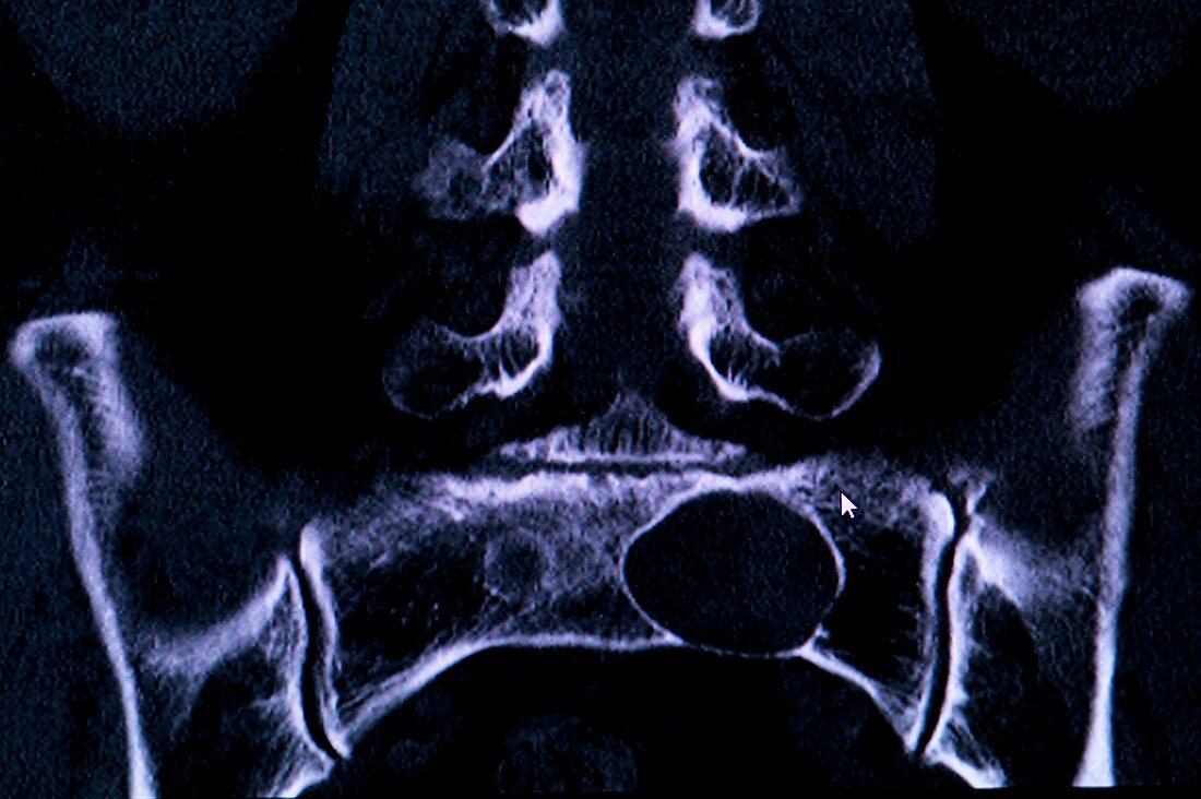 Tarlov spinal cyst,MRI scan