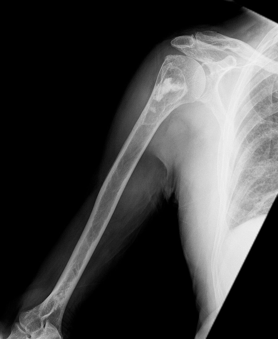 Bone death in the arm,X-ray