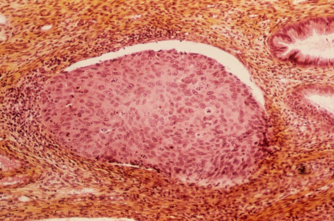 Cervical cancer,light micrograph