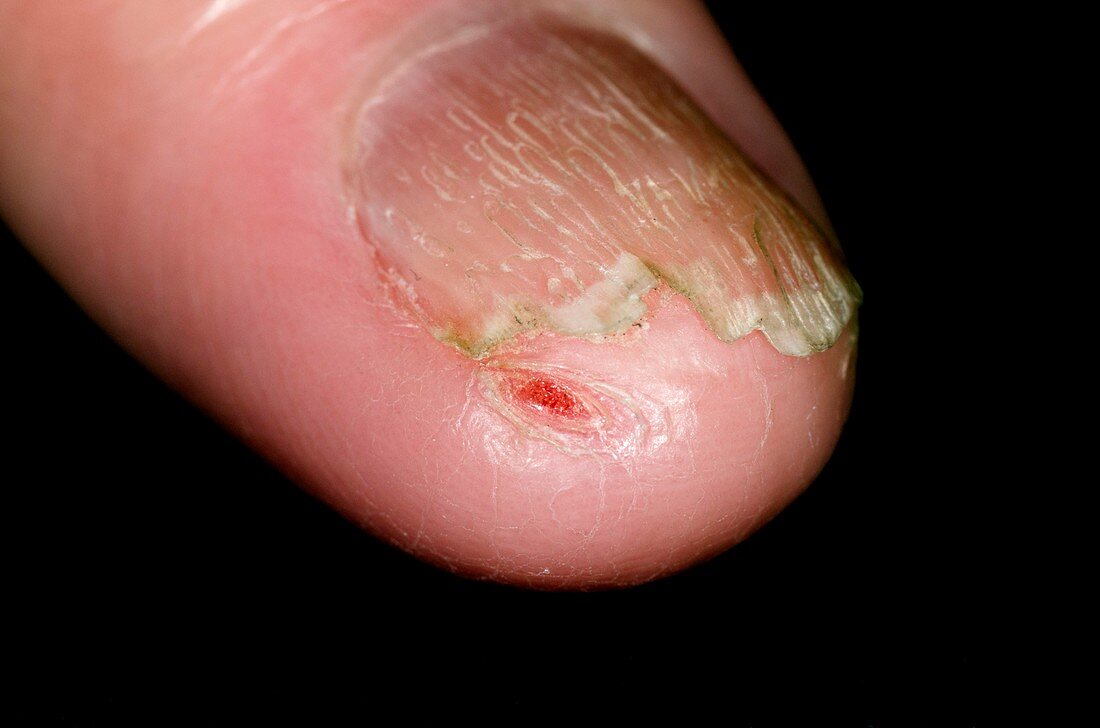 Nail dystrophy after chemotherapy