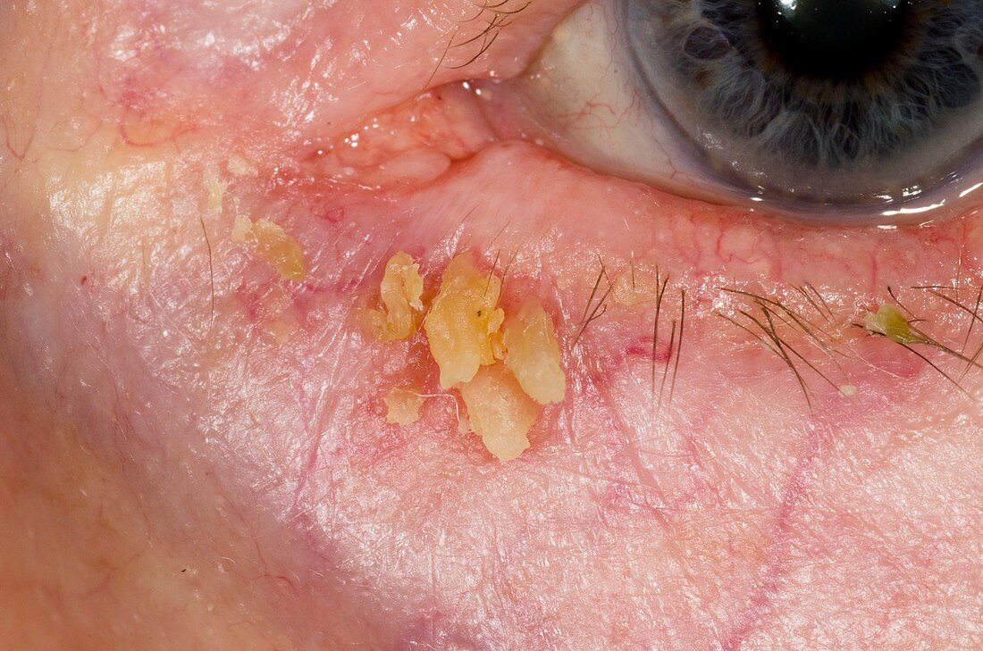 Papillomas on the lower eyelid