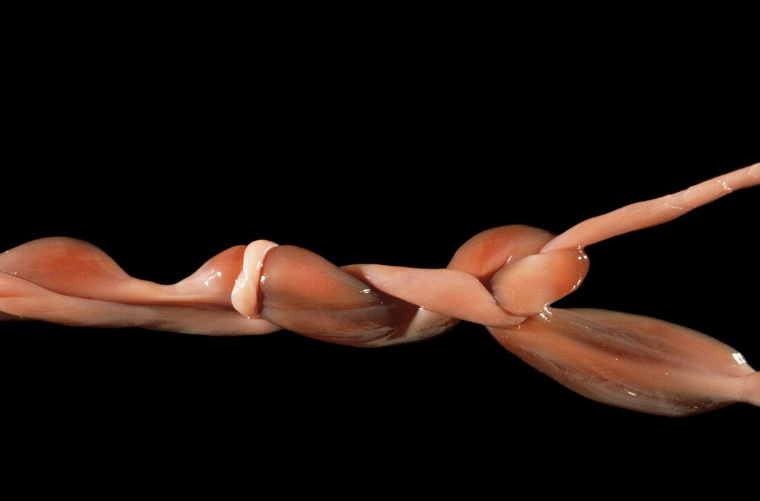 Knotted umbilical cord