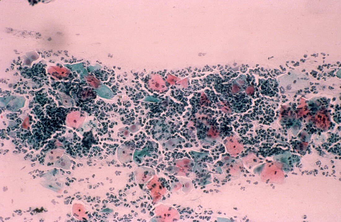 Vaginitis,light micrograph