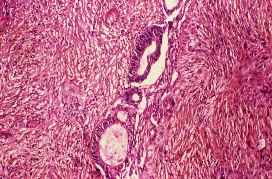 Ovarian cancer,light micrograph