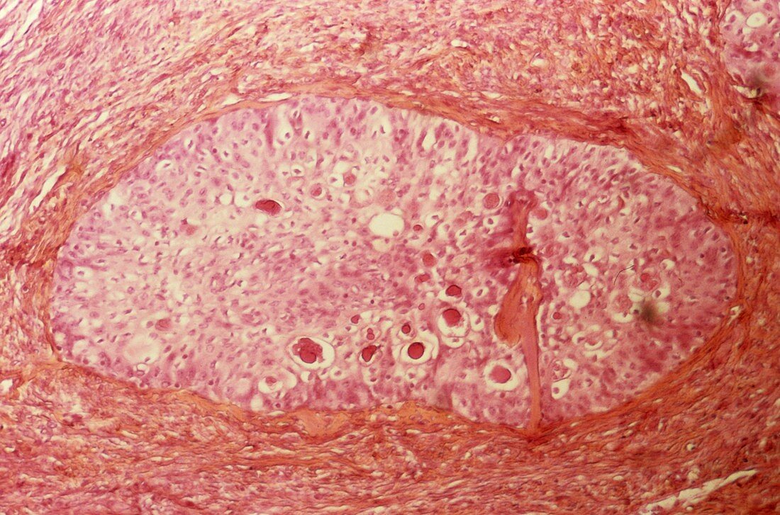 Brenner tumour of the ovary