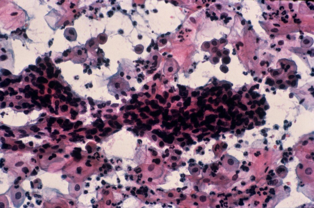 Cervical cancer,light micrograph