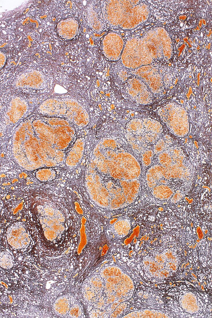 Cirrhosis of liver,light micrograph