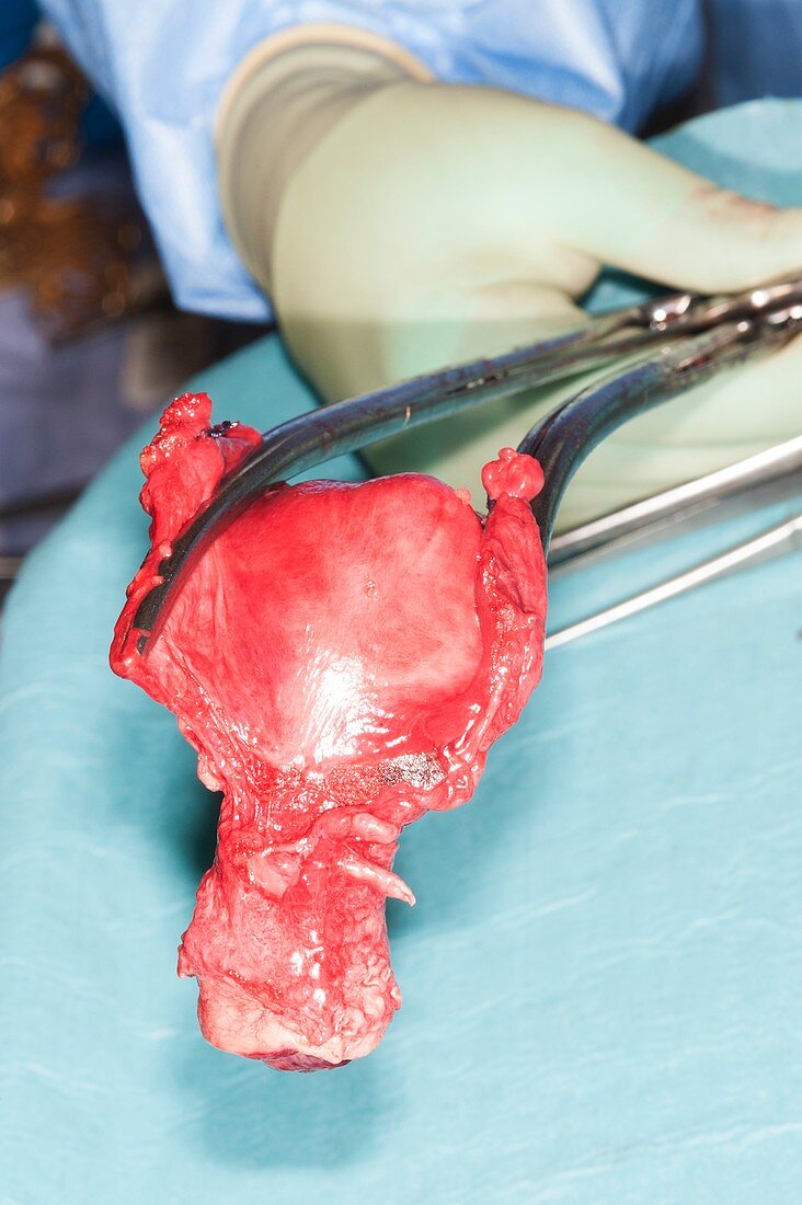 Ovarian cyst removal and hysterectomy