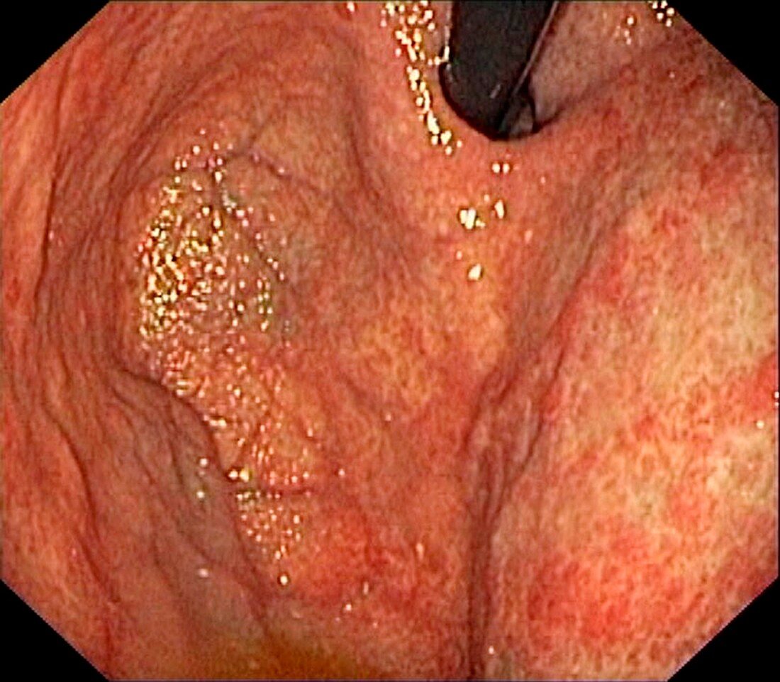 Atrophic gastritis,endoscope view
