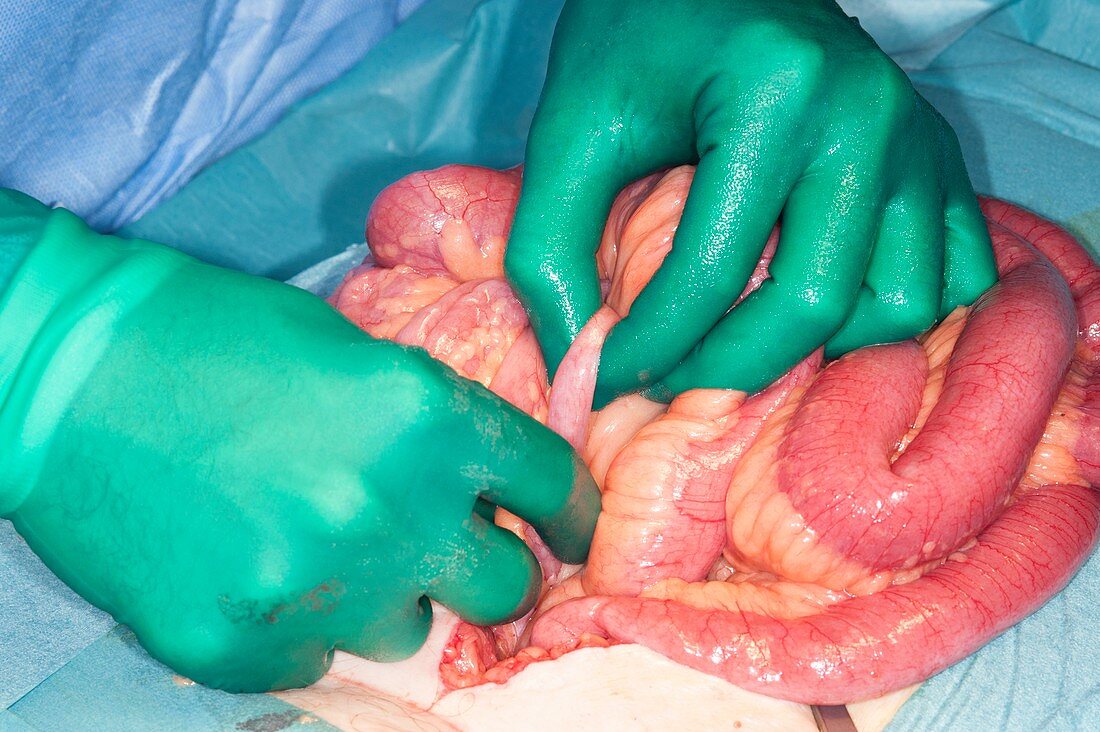 Ovarian cyst removal and hysterectomy