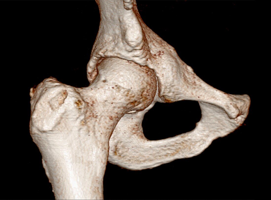 Hip,3D bone reconstruction from MRI Data
