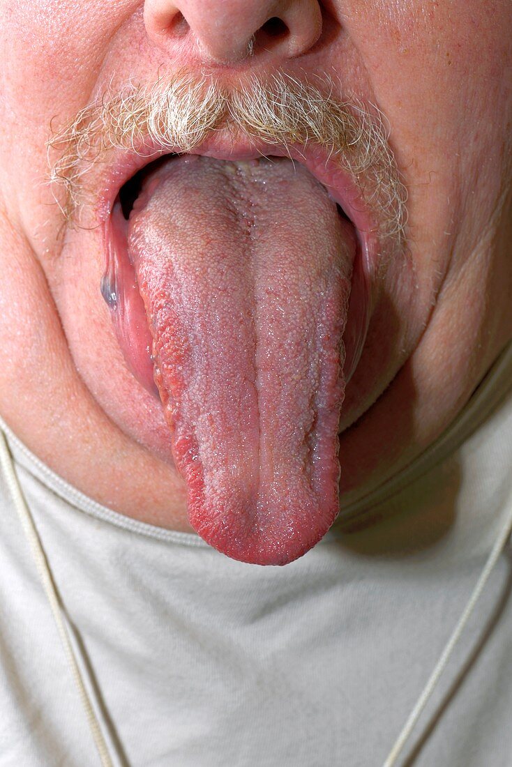 Enlarged tongue