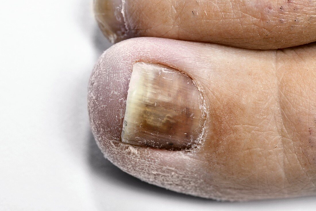 Fungal infection of the toenails