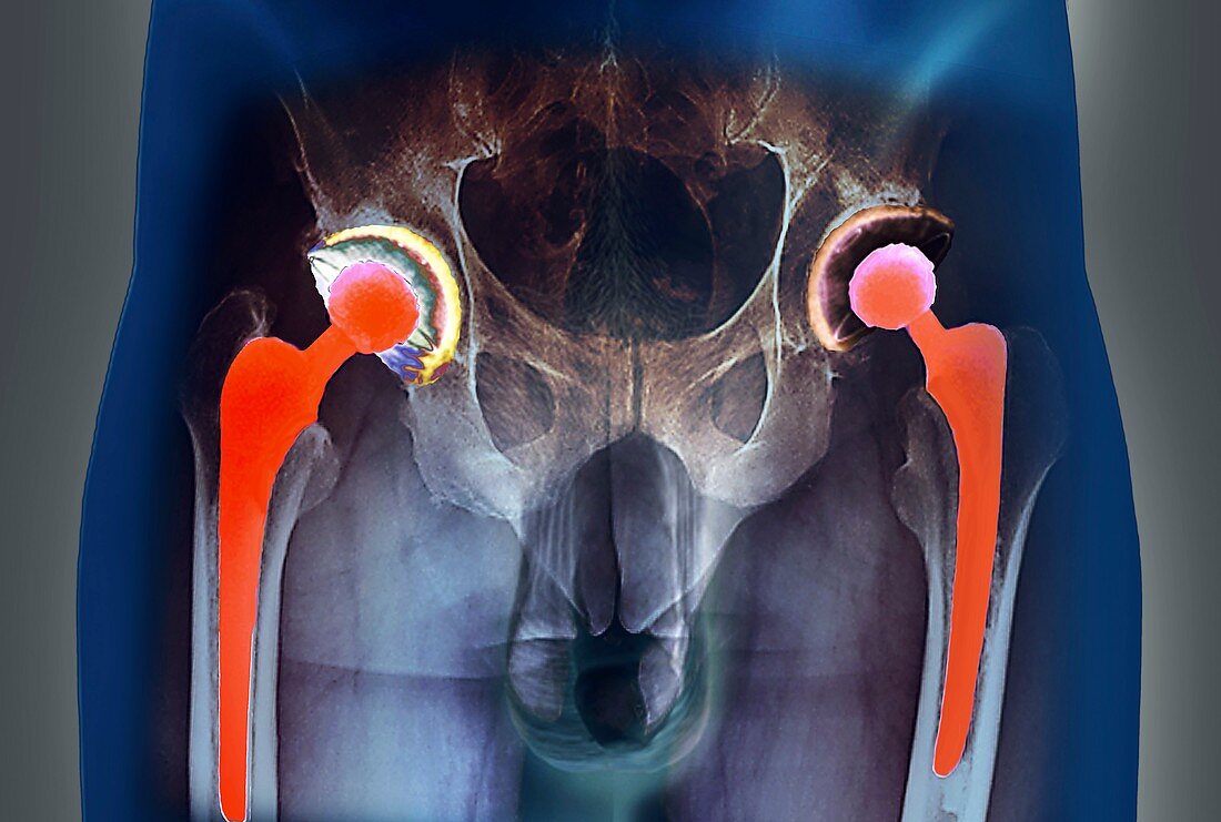 Double hip replacement,X-ray
