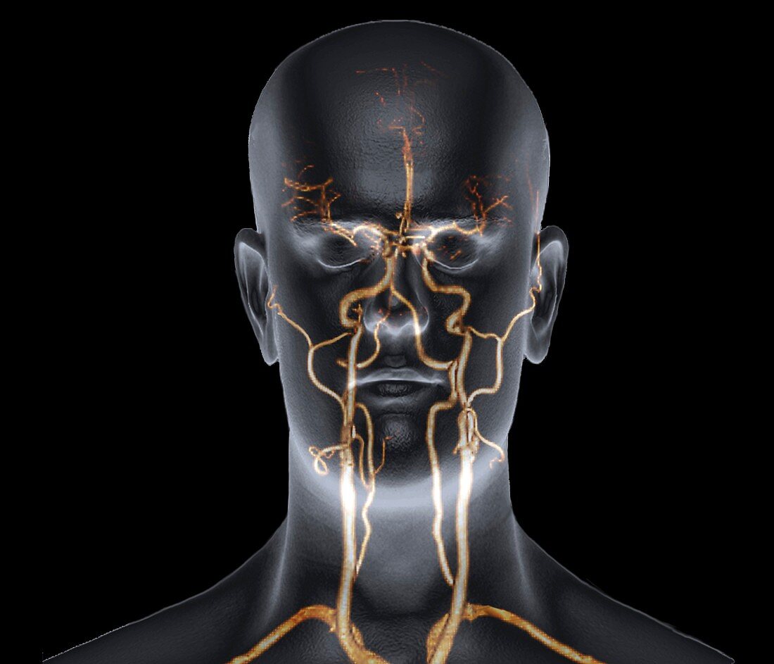 Neck and head arteries,MRA scan