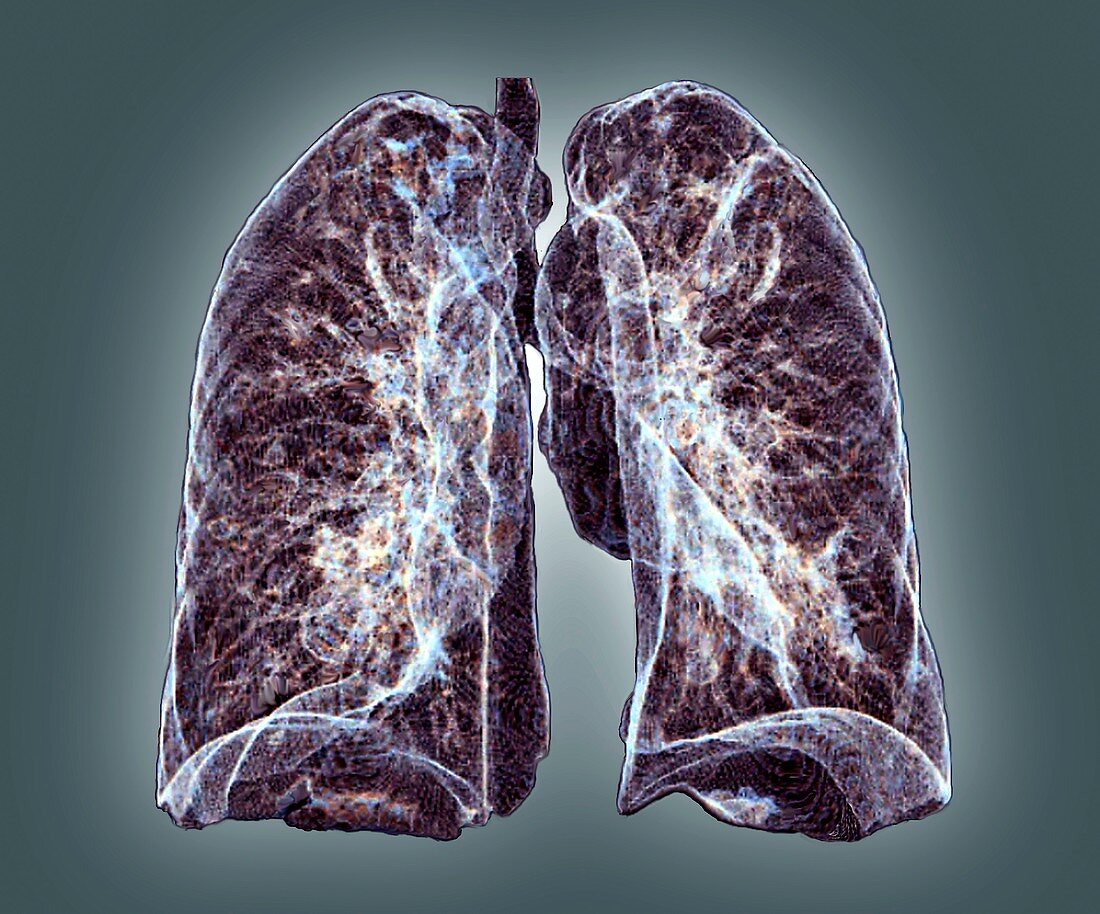 Healthy lungs,3D CT scan