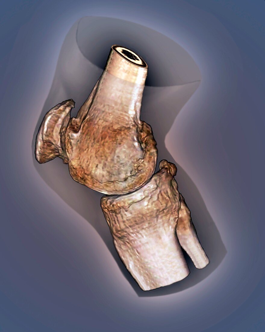 Arthritis of the knee,3D CT scan