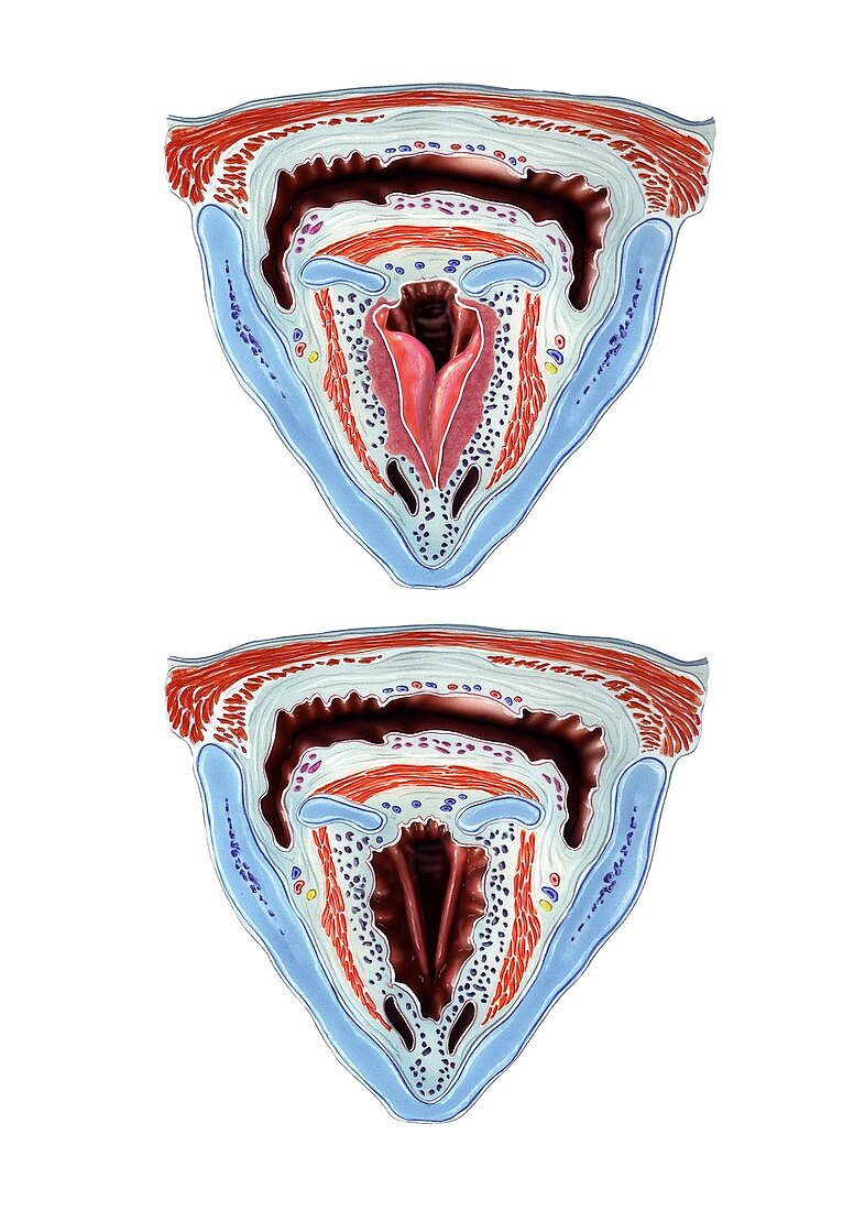 Oedema of larynx,artwork
