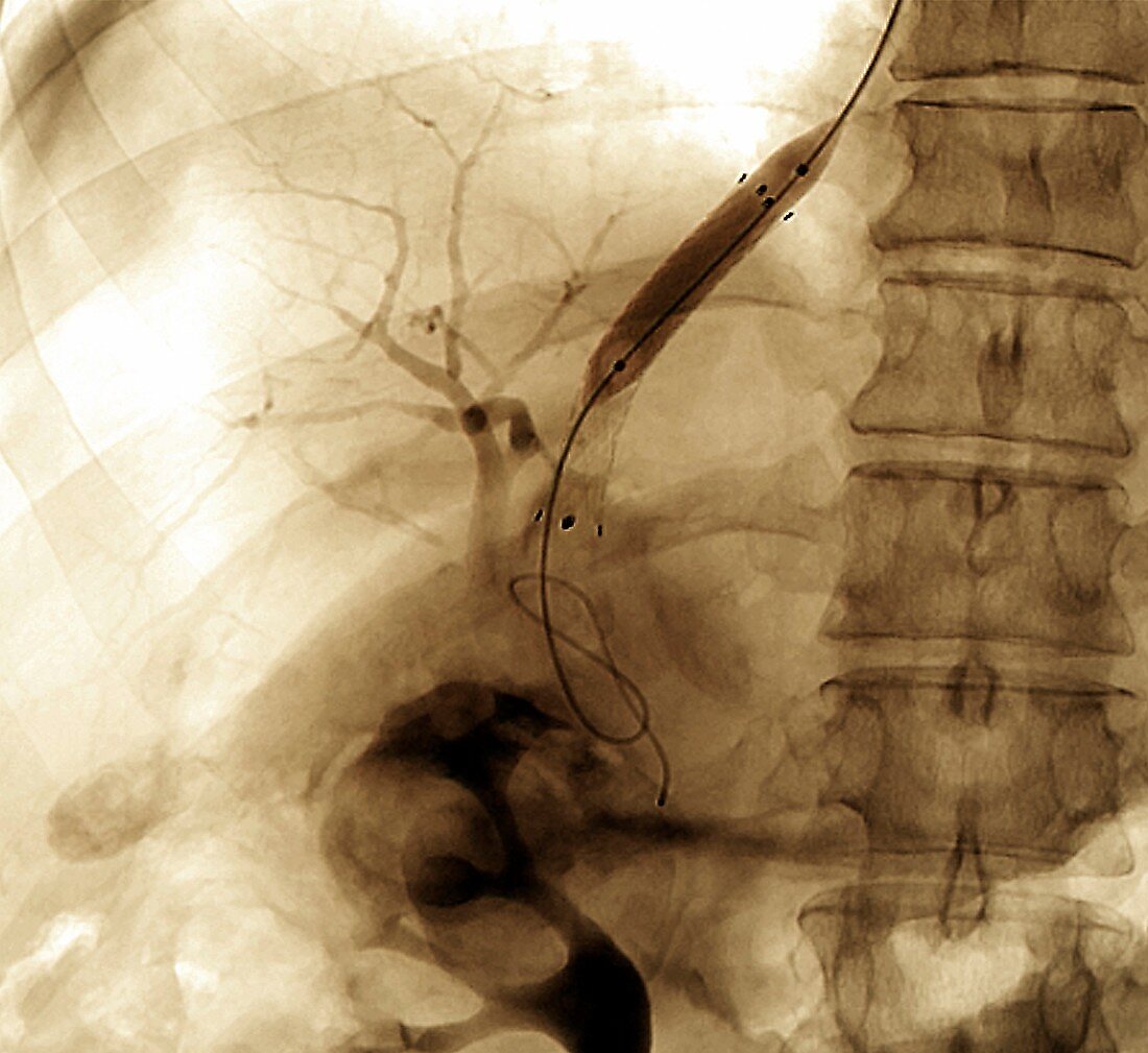 Portal vein surgery,X-ray