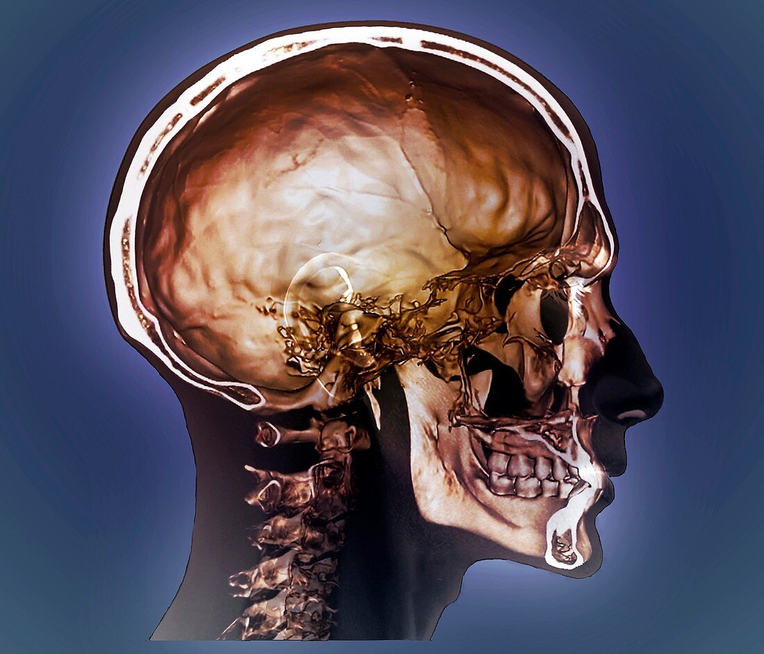 Normal head and neck,3D CT scan