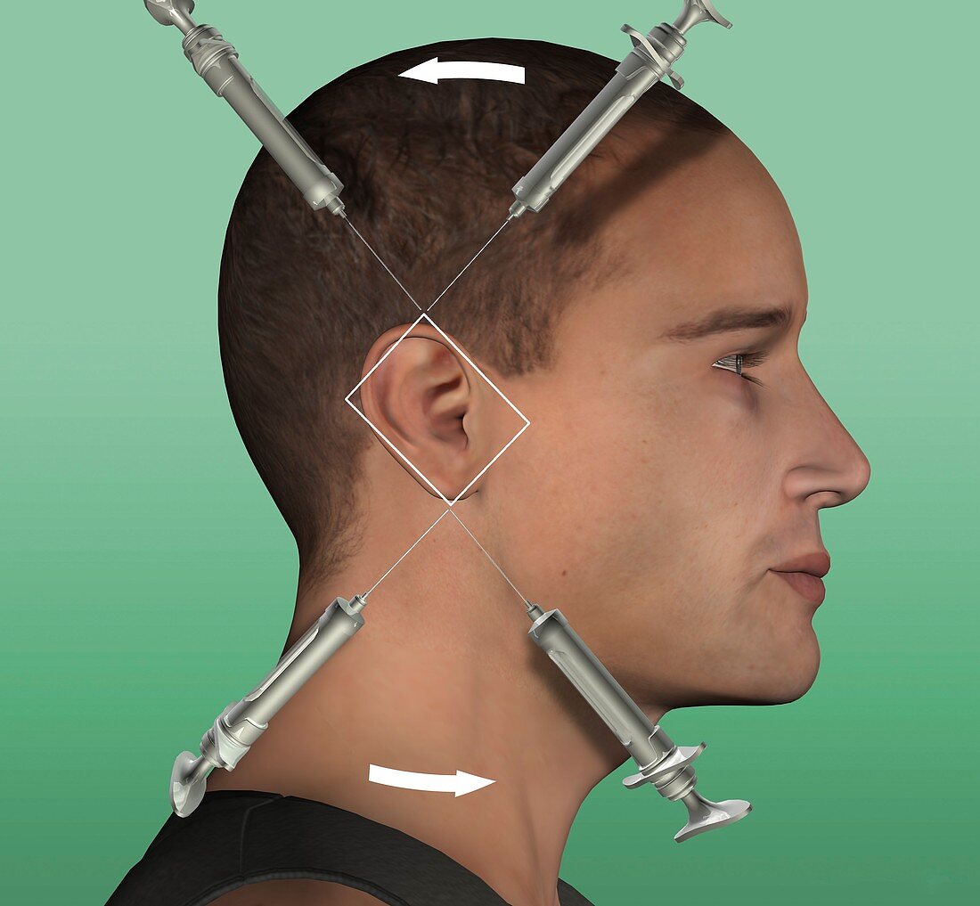 Ear nerve block,artwork