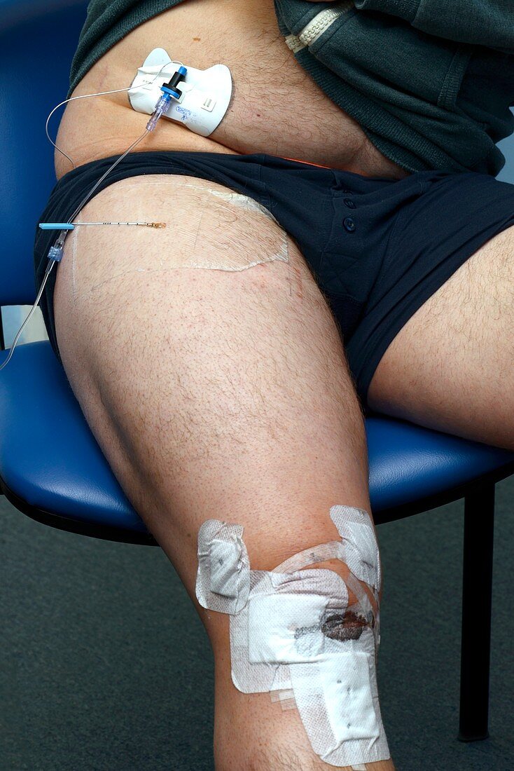 Pain control after knee surgery