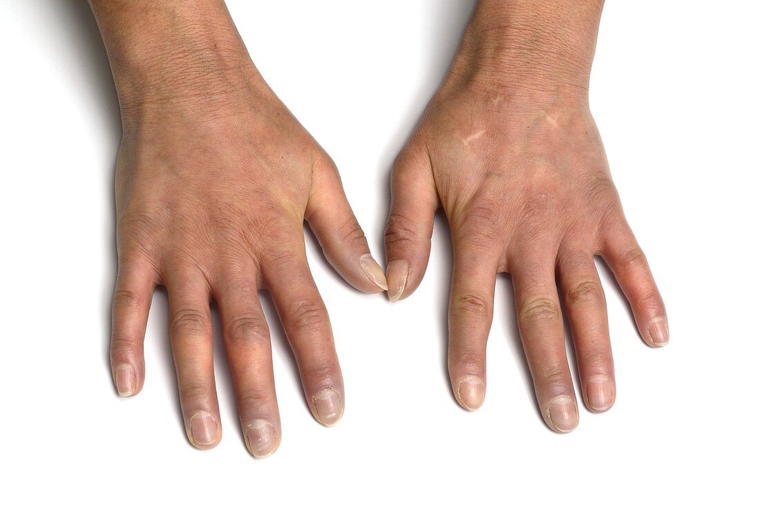 Scleroderma of the fingers